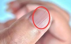 指甲上有竖纹是怎么回事？指甲上有黑线及手指甲上有竖纹怎